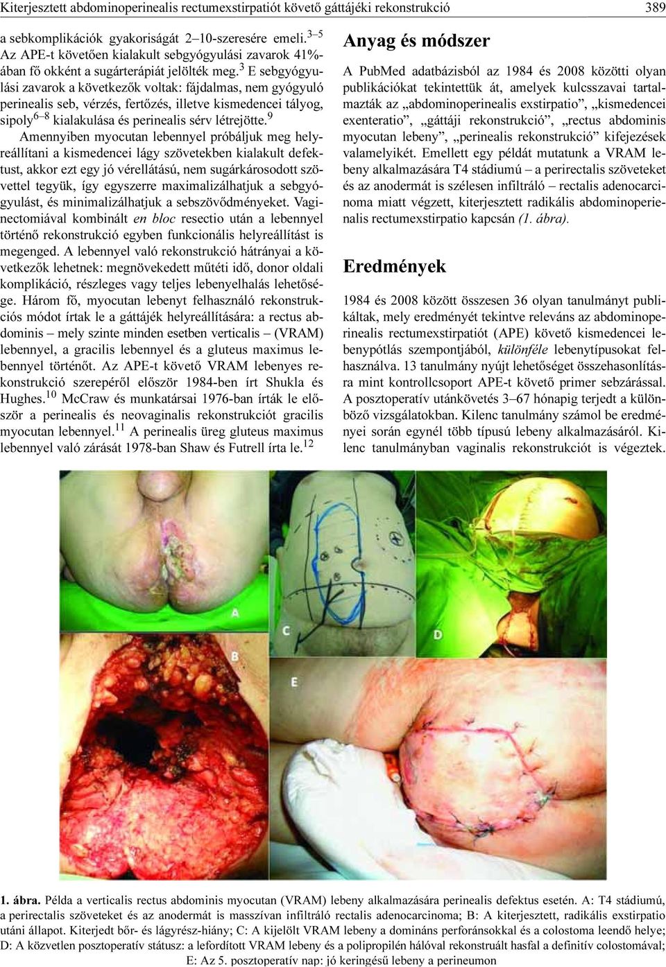 3 E sebgyógyulási zavarok a következők voltak: fájdalmas, nem gyógyuló perinealis seb, vérzés, fertőzés, illetve kismedencei tályog, sipoly 6 8 kialakulása és perinealis sérv létrejötte.