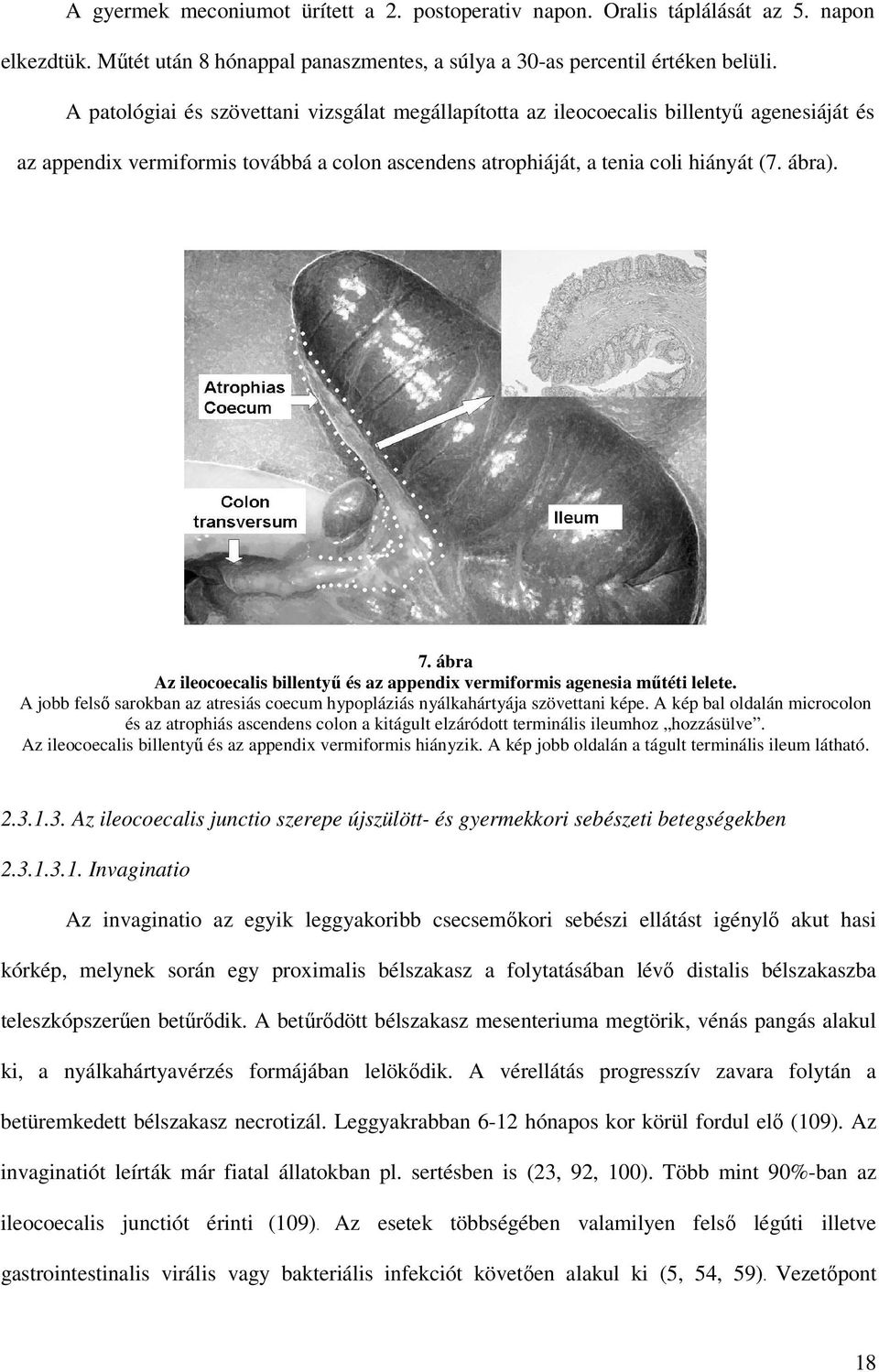 ábra Az ileocoecalis billentyő és az appendix vermiformis agenesia mőtéti lelete. A jobb felsı sarokban az atresiás coecum hypopláziás nyálkahártyája szövettani képe.