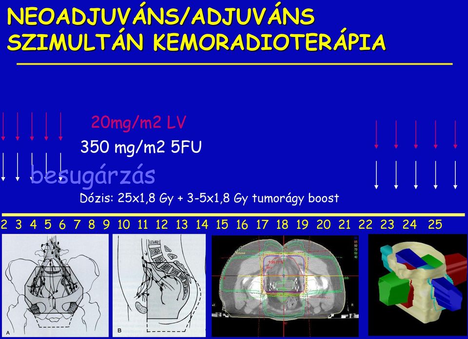 25x1,8 Gy + 3-5x1,8 Gy tumorágy boost 2 3 4 5 6
