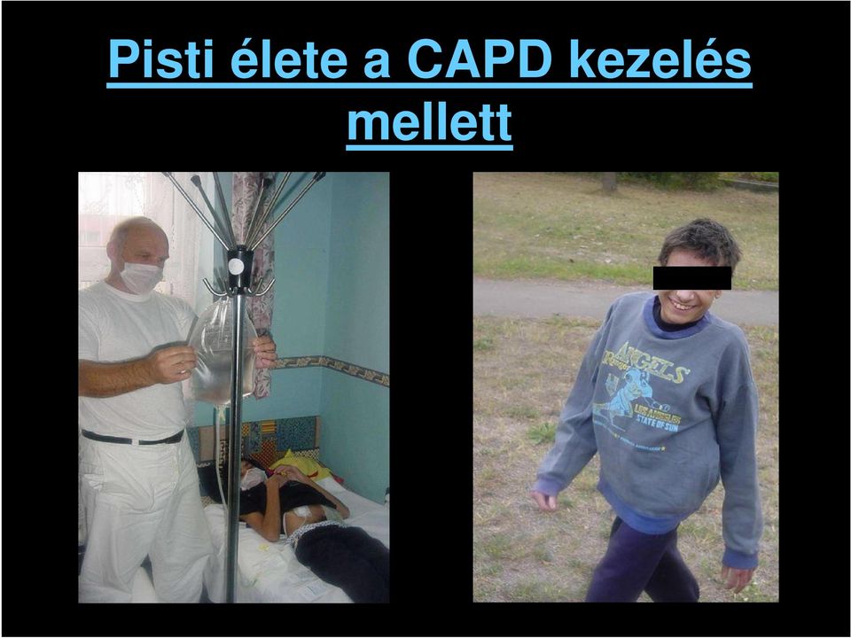 CAPD