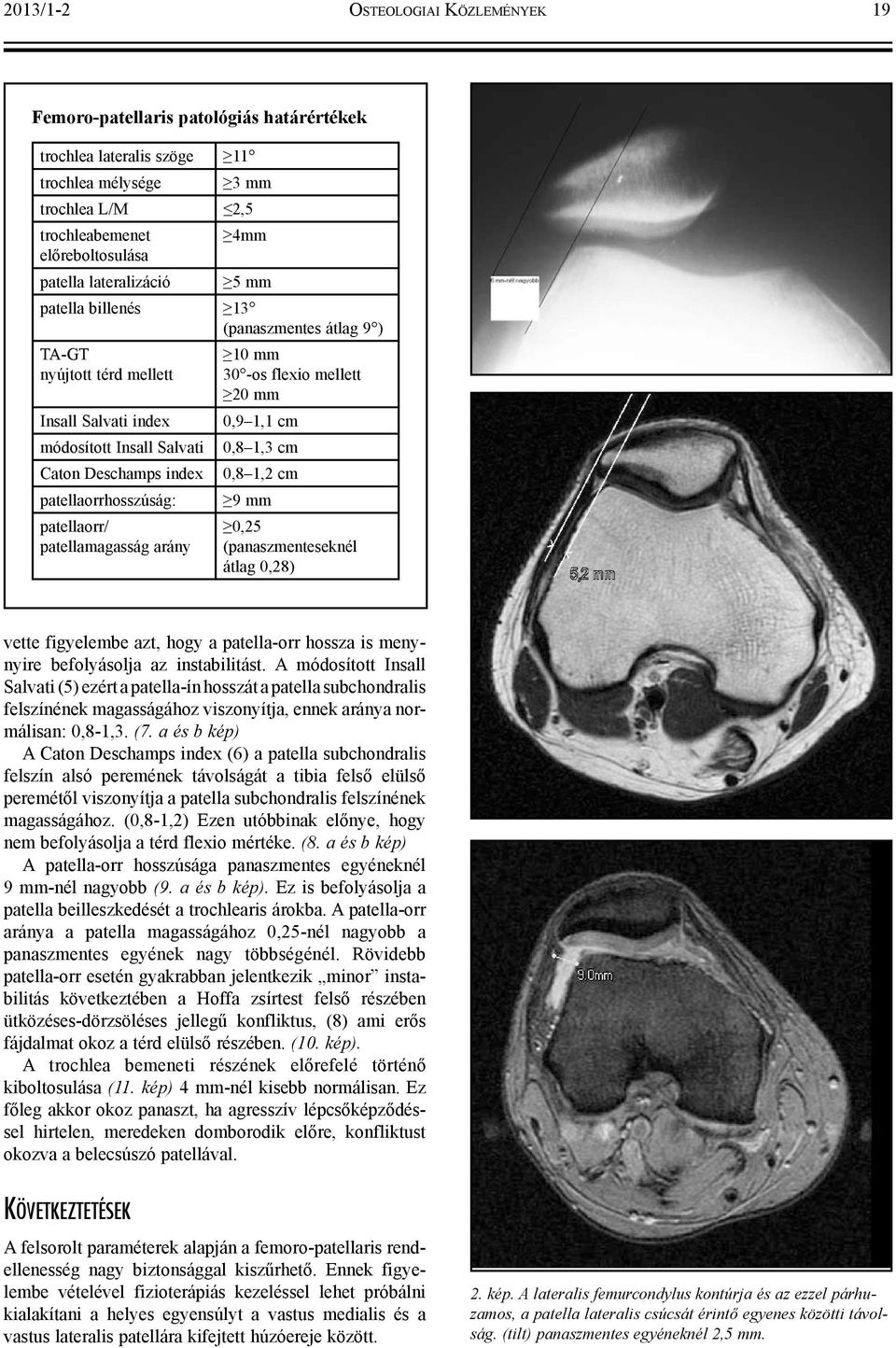 patellamagasság arány 10 mm 30 -os flexio mellett 20 mm 0,9 1,1 cm 0,8 1,3 cm 0,8 1,2 cm 9 mm 0,25 (panaszmenteseknél átlag 0,28) vette figyelembe azt, hogy a patella-orr hossza is menynyire