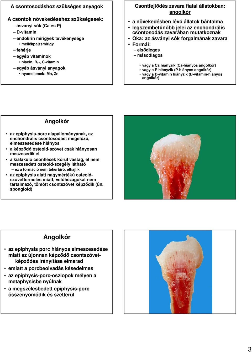 forgalmának zavara Formái: elsıdleges másodlagos vagy a Ca hiányzik (Ca-hiányos angolkór) vagy a P hiányzik (P-hiányos angolkór) vagy a D-vitamin hiányzik (D-vitamin-hiányos angolkór) Angolkór az