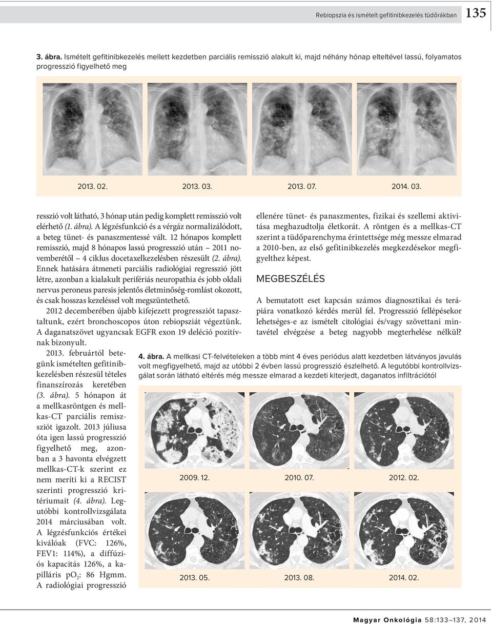 2013. 07. 2014. 03. resszió volt látható, 3 hónap után pedig komplett remisszió volt elérhető (1. ábra). A légzésfunkció és a vérgáz normalizálódott, a beteg tünet- és panaszmentessé vált.