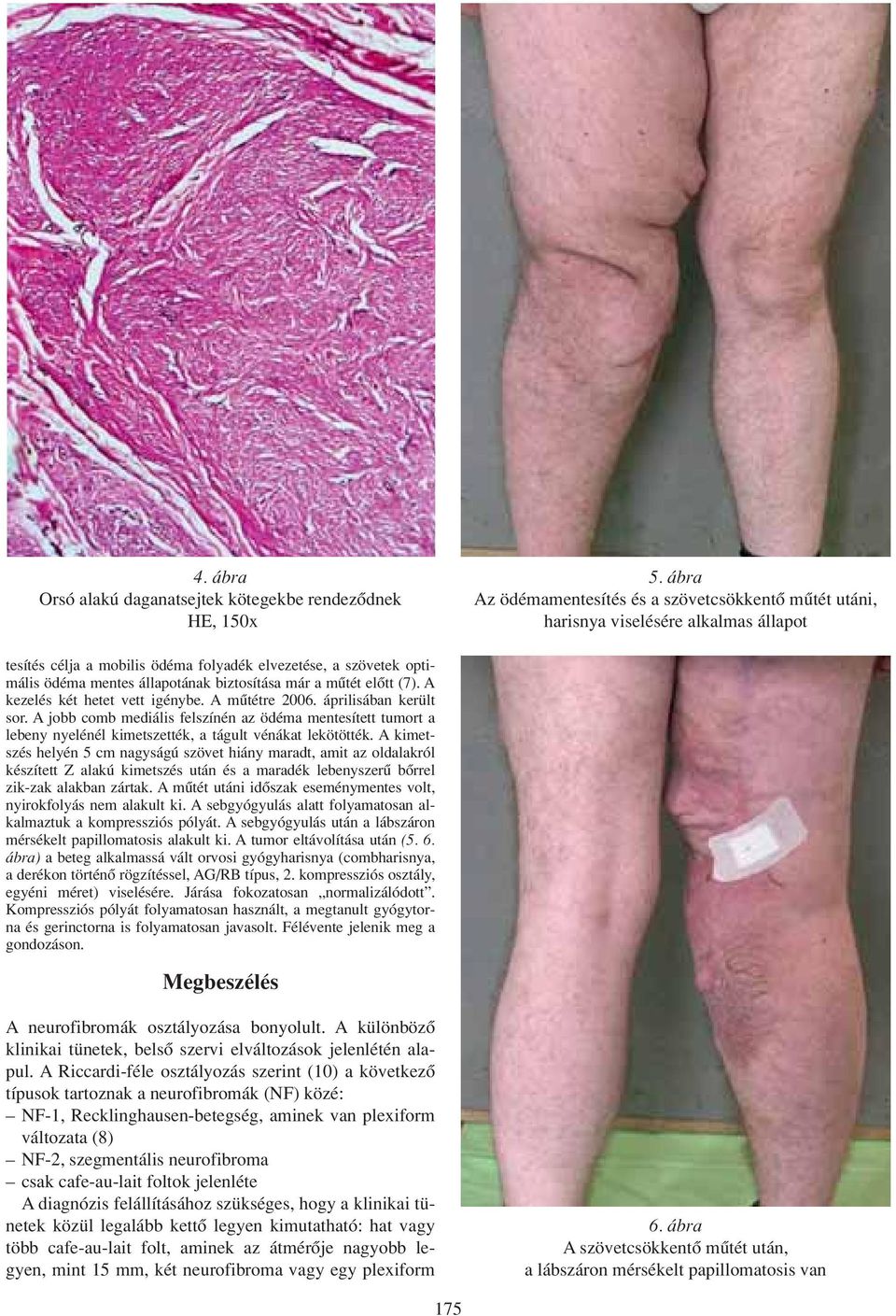 Plexiform neurofibroma az alsó végtagon, elephantiasis neurofibromatosa.  Plexiform neurofibroma of the lower limb, elephantiasis neurofibromatosa -  PDF Ingyenes letöltés