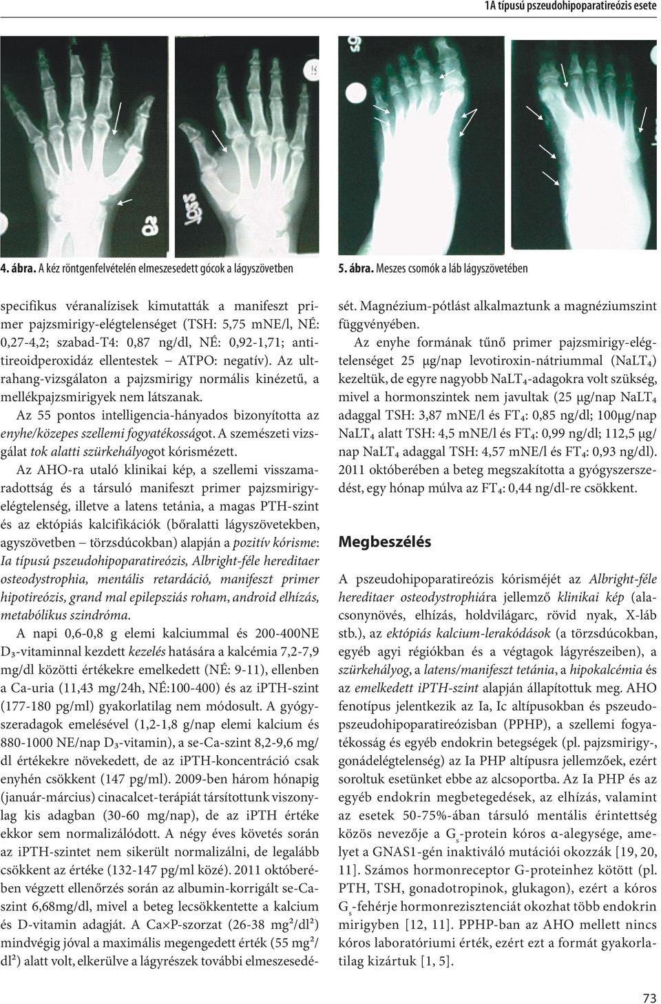 Meszes csomók a láb lágyszövetében specifikus véranalízisek kimutatták a manifeszt primer pajzsmirigy-elégtelenséget (TSH: 5,75 mne/l, NÉ: 0,27-4,2; szabad-t4: 0,87 ng/dl, NÉ: 0,92-1,71;