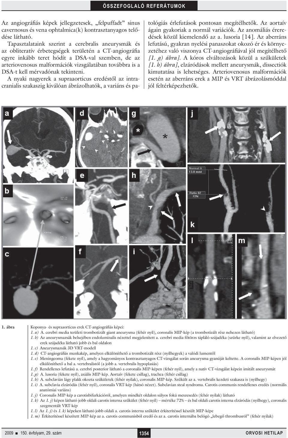 továbbra is a DSA-t kell mérvadónak tekinteni. A nyaki nagyerek a supraaorticus eredéstől az intracranialis szakaszig kiválóan ábrázolhatók, a variáns és patológiás érlefutások pontosan megítélhetők.