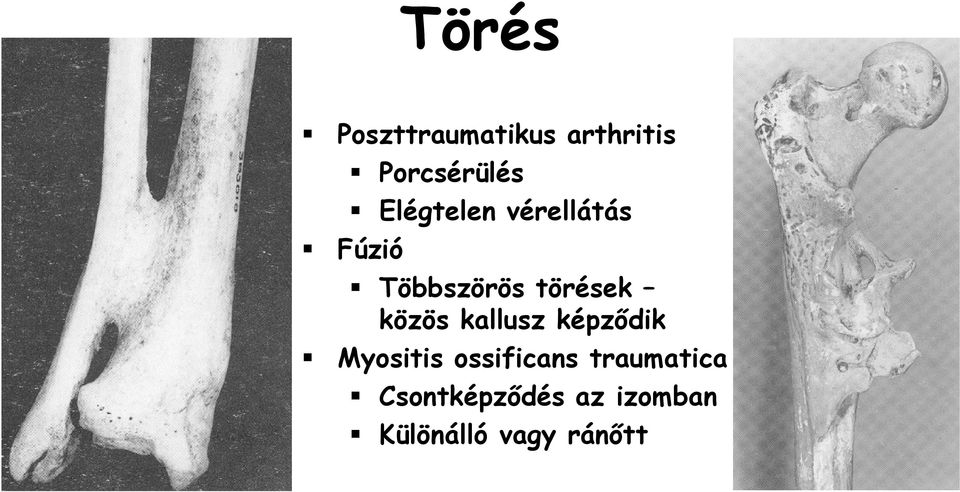 közös kallusz képzıdik Myositis ossificans