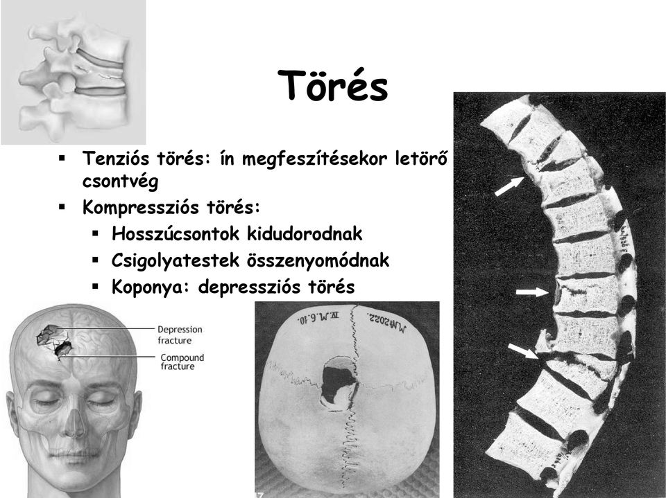 Hosszúcsontok kidudorodnak