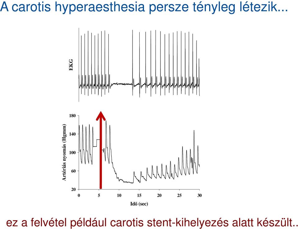 .. EKG 180 Artériás nyomás (Hgmm) 140 100 60