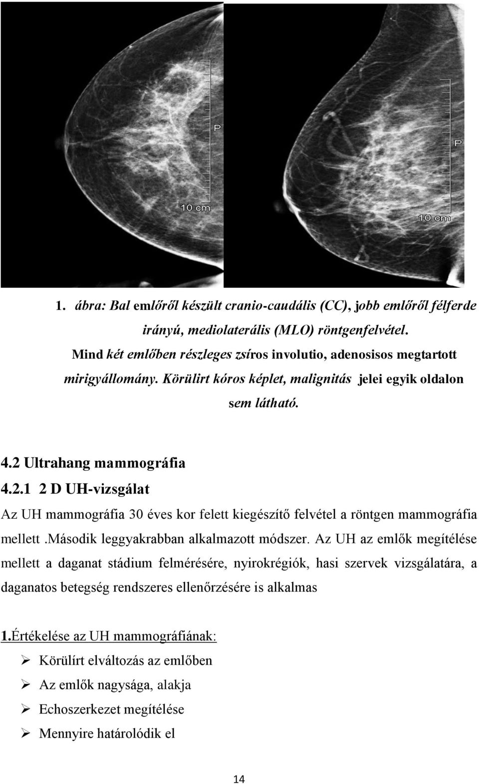 Ultrahang mammográfia 4.2.1 2 D UH-vizsgálat Az UH mammográfia 30 éves kor felett kiegészítő felvétel a röntgen mammográfia mellett.második leggyakrabban alkalmazott módszer.