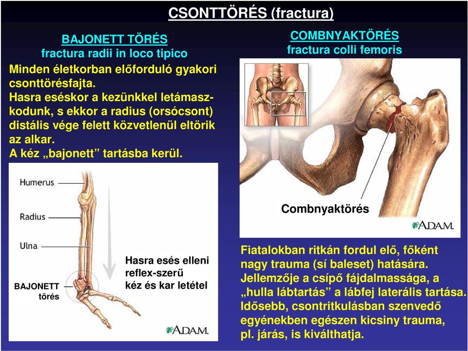 CSONTTÖRÉS (fractura) COMBNYAKTÖRÉS fractura colli femoris Combnyaktörés BAJONETT törés Hasra esés elleni reflex-szerő kéz és kar letétel Fiatalokban ritkán