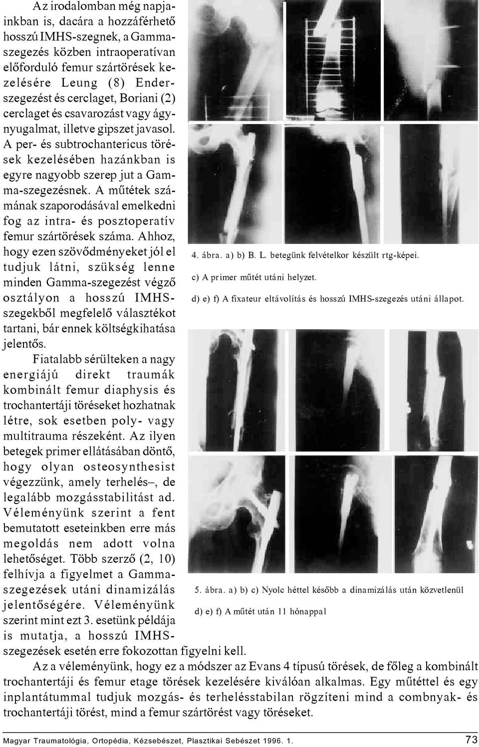 A mûtétek számának szaporodásával emelkedni fog az intra- és posztoperatív femur szártörések száma. Ahhoz, hogy ezen szövôdményeket jól el 4. ábra. a) b) B. L. betegünk felvételkor készült rtg-képei.