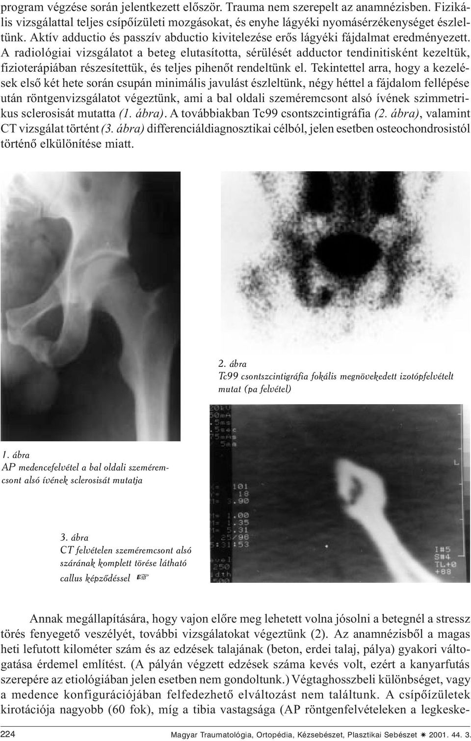 A radiológiai vizsgálatot a beteg elutasította, sérülését adductor tendinitisként kezeltük, fizioterápiában részesítettük, és teljes pihenõt rendeltünk el.