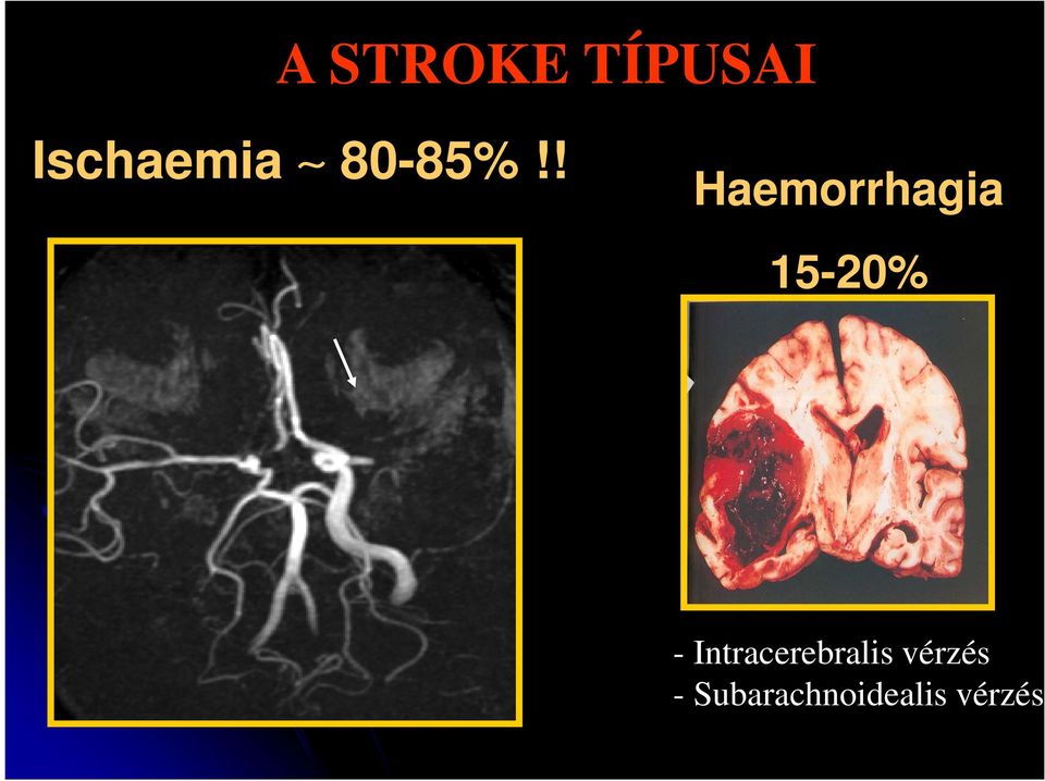 ! Haemorrhagia 15-20% -