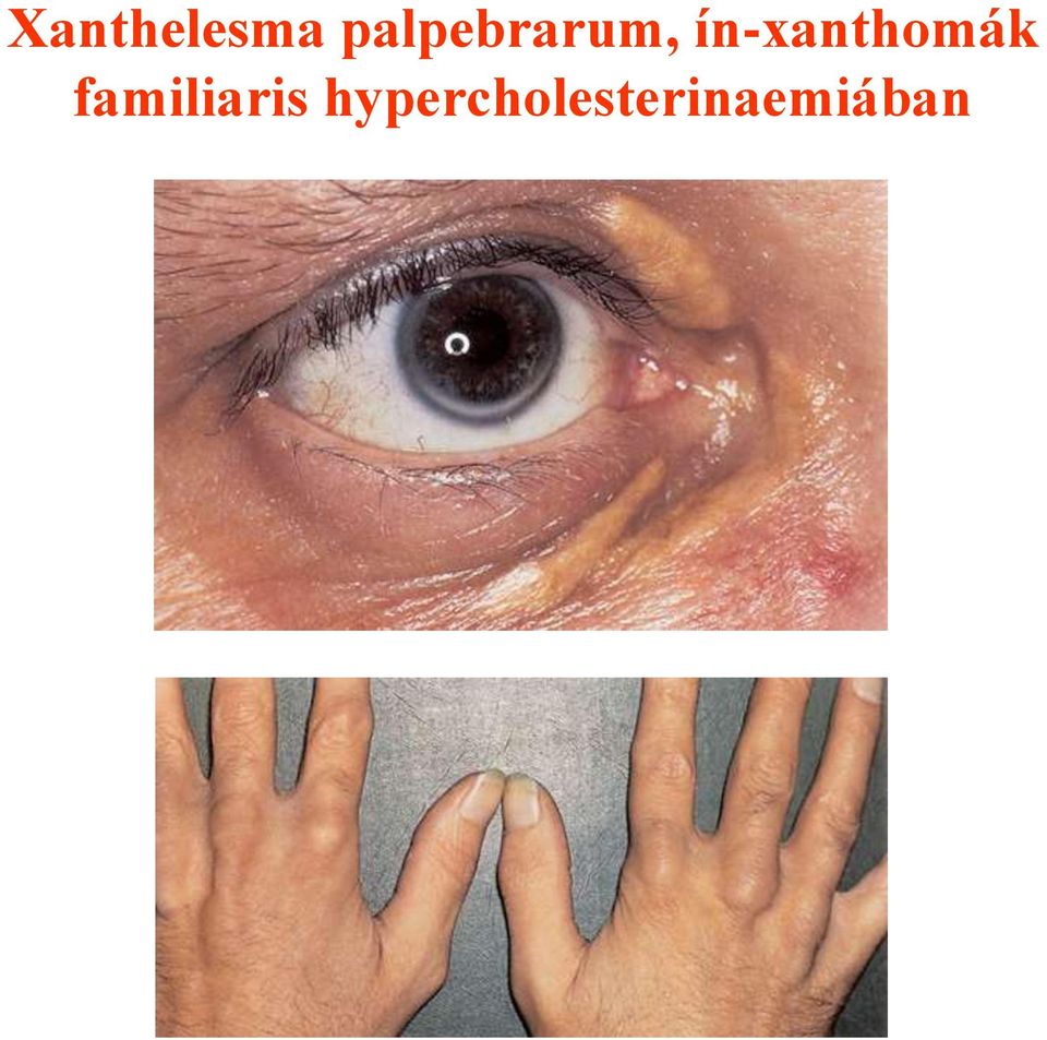 ín-xanthomák