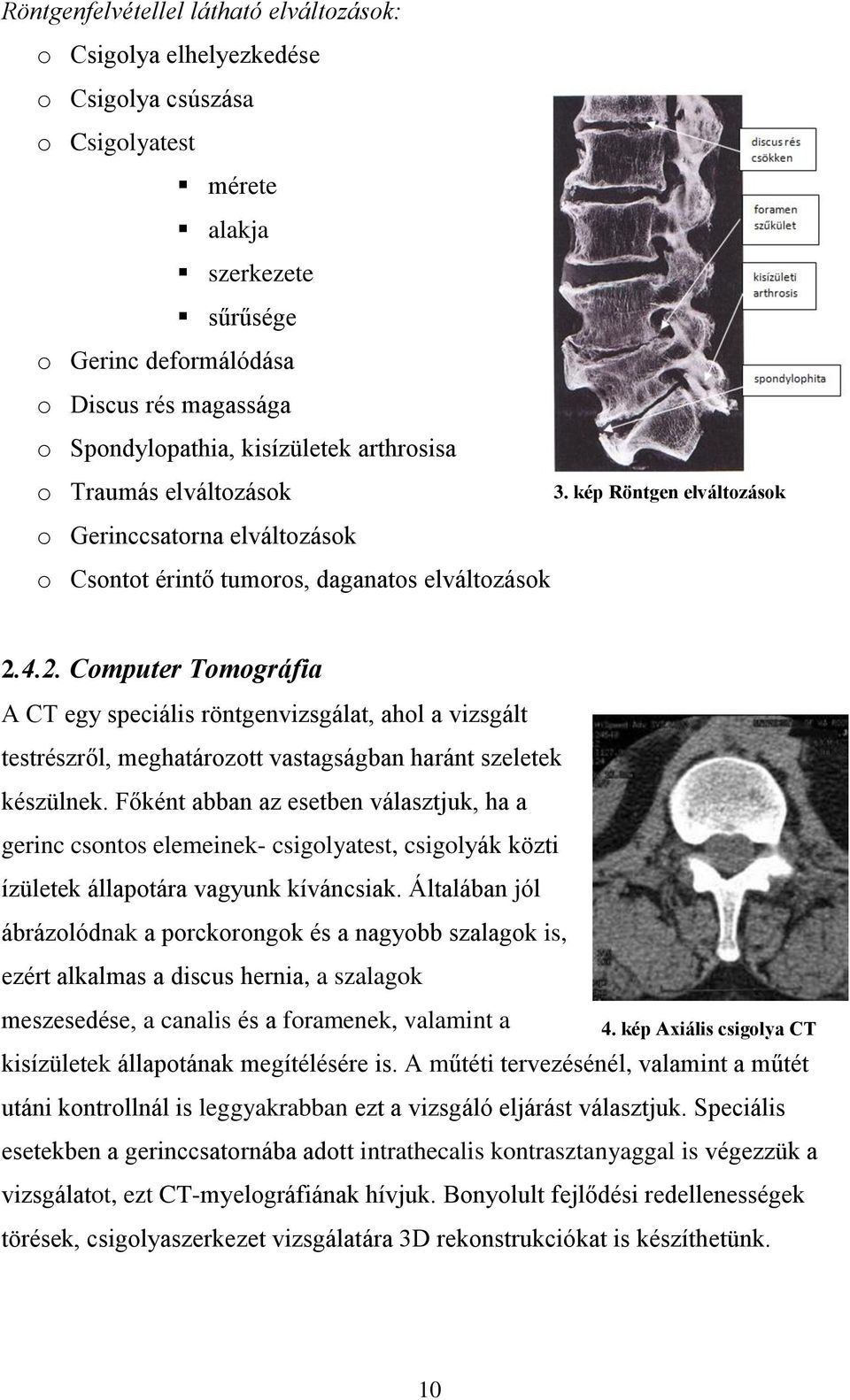 4.2. Computer Tomográfia A CT egy speciális röntgenvizsgálat, ahol a vizsgált testrészről, meghatározott vastagságban haránt szeletek készülnek.