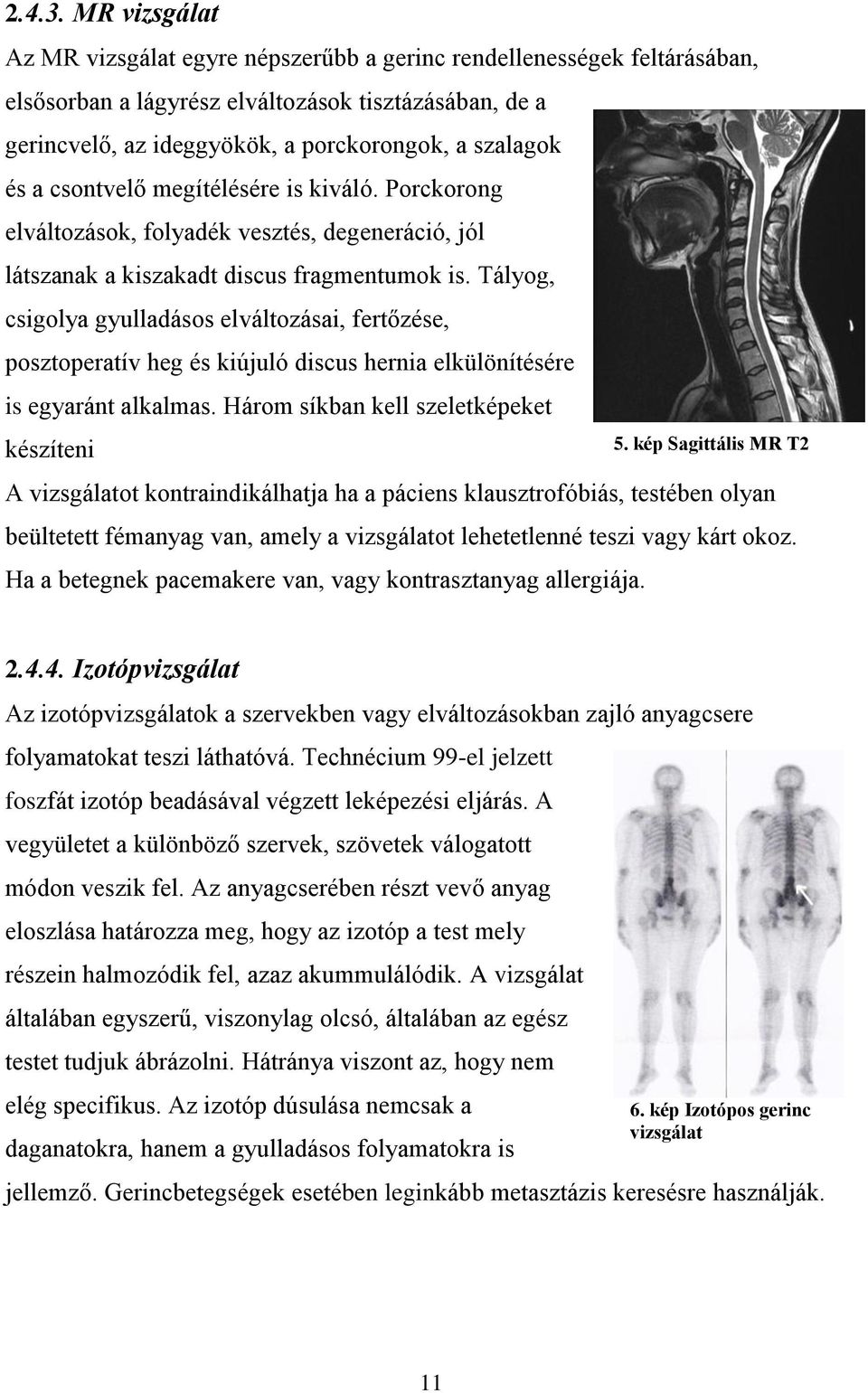 csontvelő megítélésére is kiváló. Porckorong elváltozások, folyadék vesztés, degeneráció, jól látszanak a kiszakadt discus fragmentumok is.