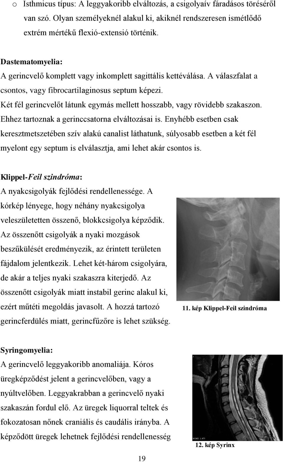 Két fél gerincvelőt látunk egymás mellett hosszabb, vagy rövidebb szakaszon. Ehhez tartoznak a gerinccsatorna elváltozásai is.