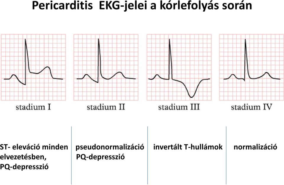 pseudonormalizáció invertált T-hullámok