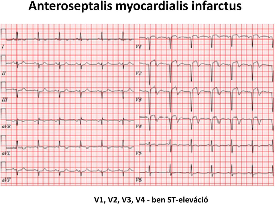 infarctus V1,V2,