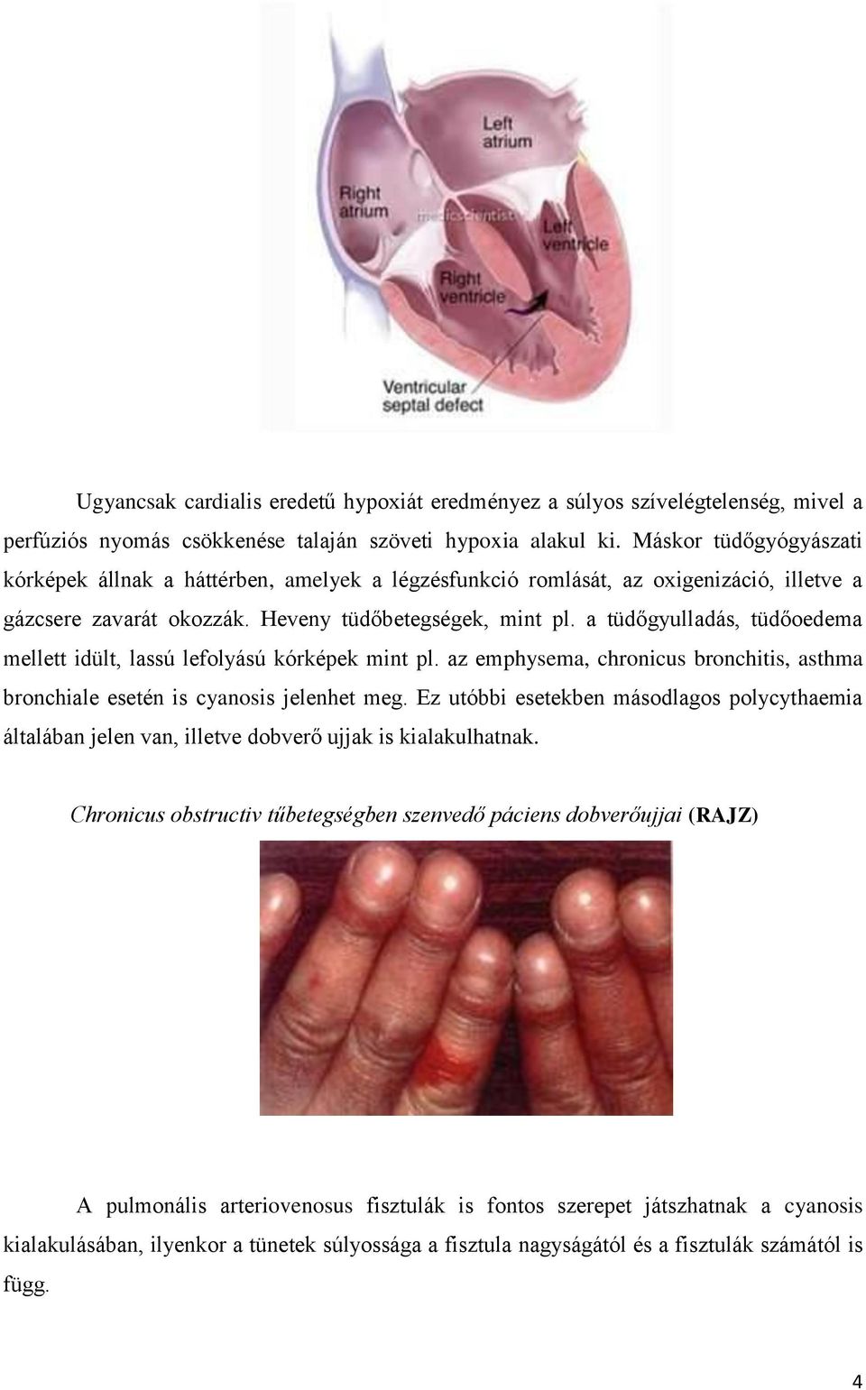 a tüdőgyulladás, tüdőoedema mellett idült, lassú lefolyású kórképek mint pl. az emphysema, chronicus bronchitis, asthma bronchiale esetén is cyanosis jelenhet meg.