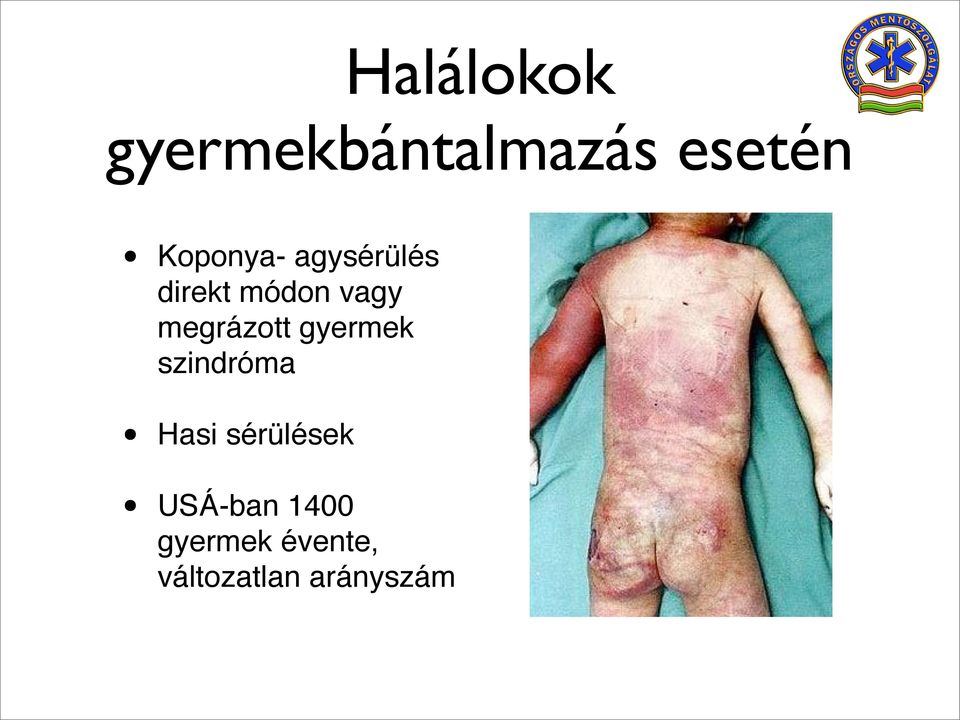 megrázott gyermek szindróma Hasi