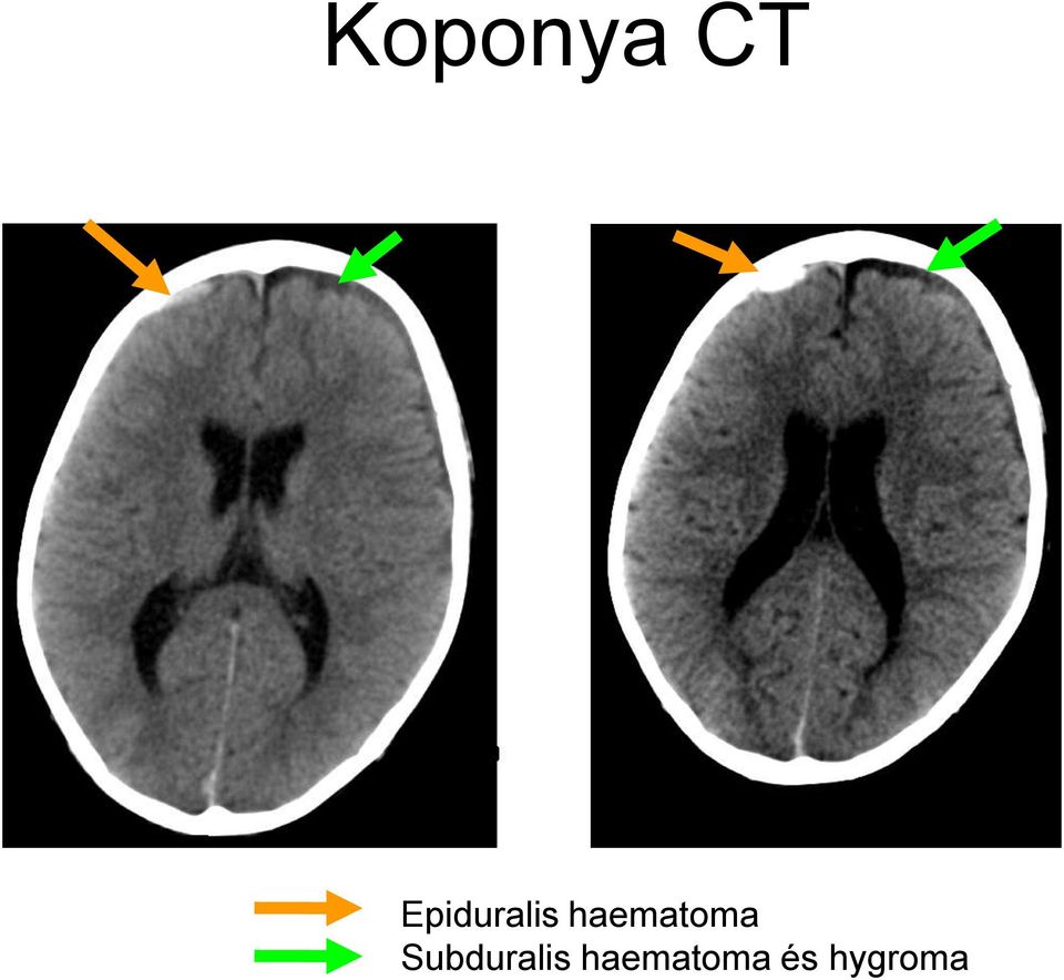 haematoma