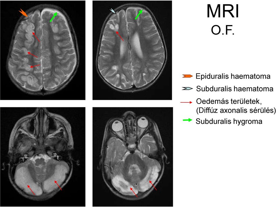 Subduralis haematoma Oedemás