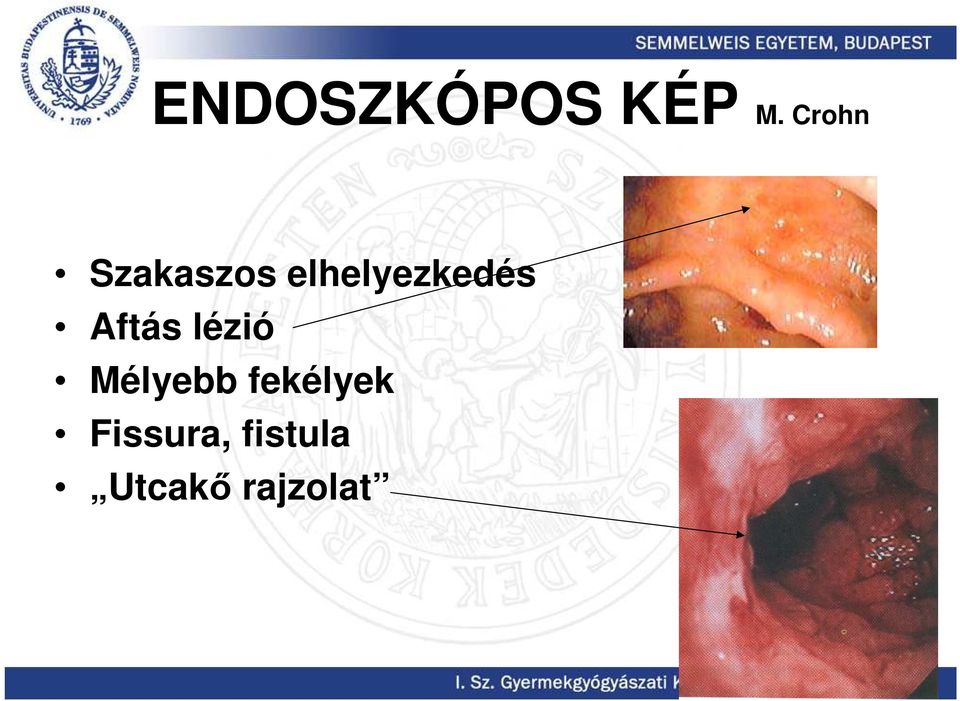 elhelyezkedés Aftás lézió