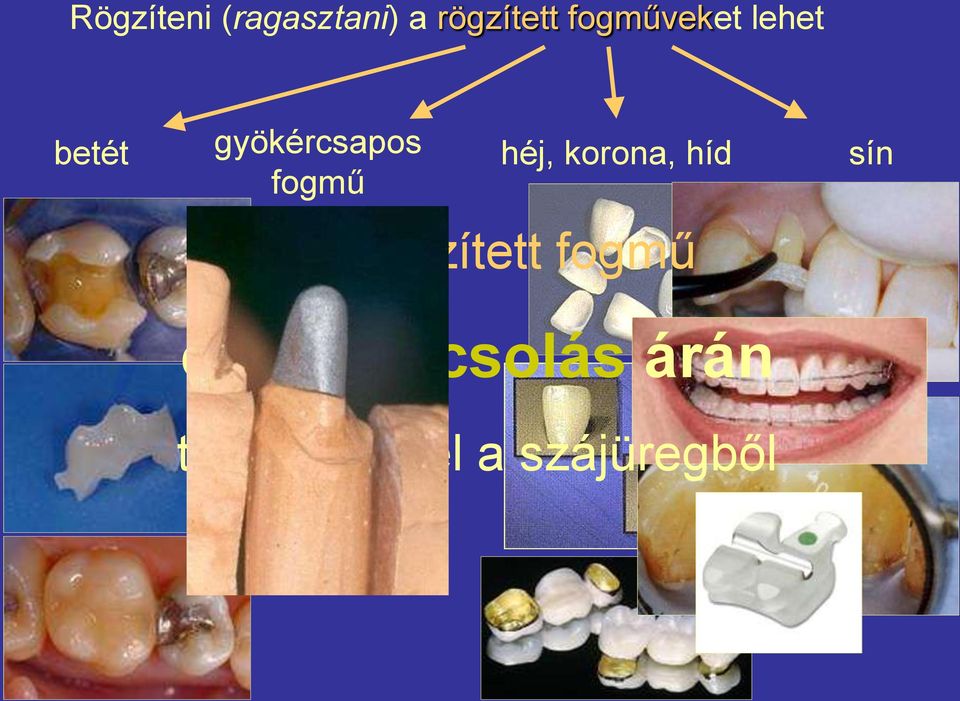 héj, korona, híd Egy rögzített fogmű sín