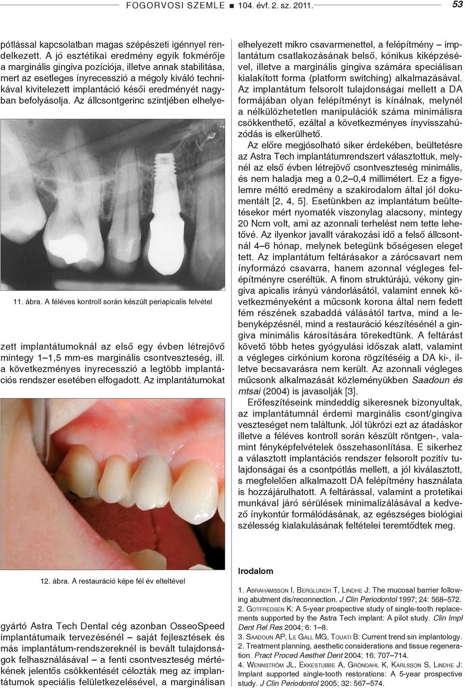 eredményét nagyban befolyásolja. Az állcsontgerinc szintjében elhelyezett implantátumoknál az első egy évben létrejövő mintegy 1 1,5 mm-es marginális csontveszteség, ill.