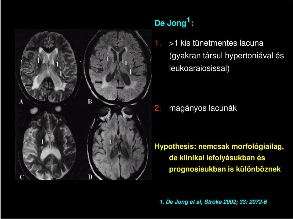 leukoaraiosissal) 2.