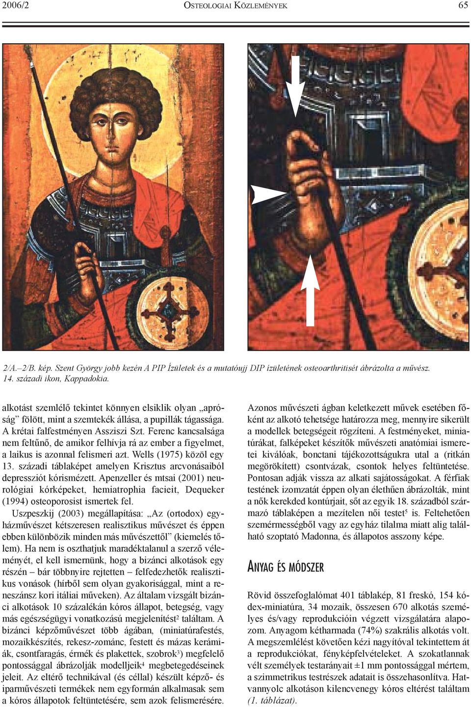 Ferenc kancsalsága nem feltûnõ, de amikor felhívja rá az ember a figyelmet, a laikus is azonnal felismeri azt. Wells (1975) közöl egy 13.