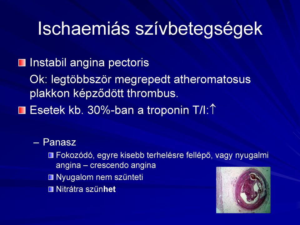 30%-ban a troponin T/I: Panasz Fokozódó, egyre kisebb terhelésre