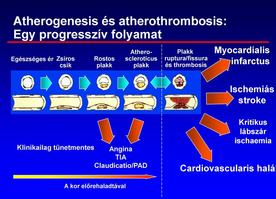 Myocardialis infarctus Ischemiás stroke Klinikailag tünetmentes Angina TIA