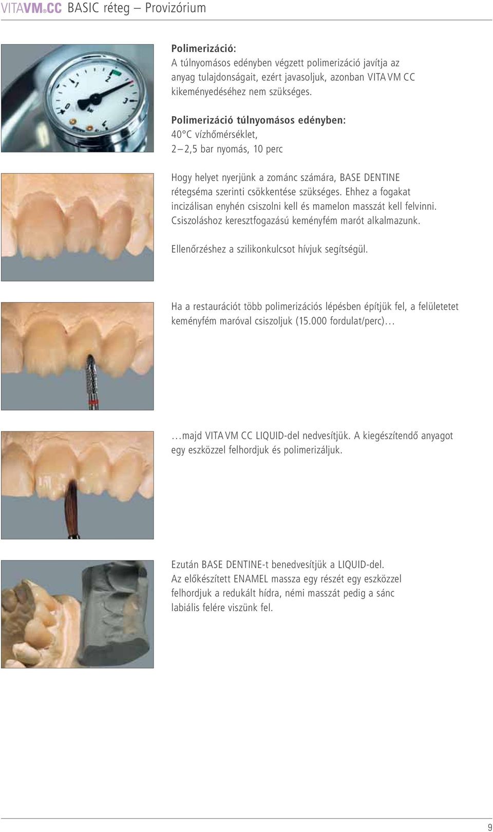 Ehhez a fogakat incizálisan enyhén csiszolni kell és mamelon masszát kell felvinni. Csiszoláshoz keresztfogazású keményfém marót alkalmazunk. Ellenőrzéshez a szilikonkulcsot hívjuk segítségül.