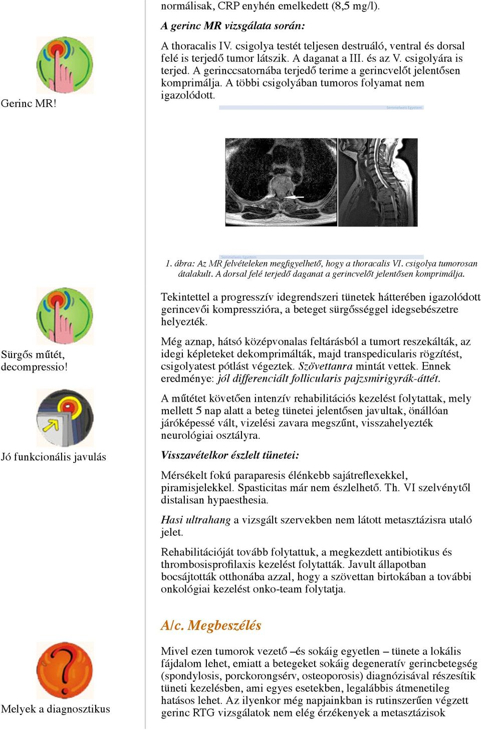 ábra: Az MR felvételeken megfigyelhető, hogy a thoracalis VI. csigolya tumorosan átalakult. A dorsal felé terjedő daganat a gerincvelőt jelentősen komprimálja. Sürgős műtét, decompressio!