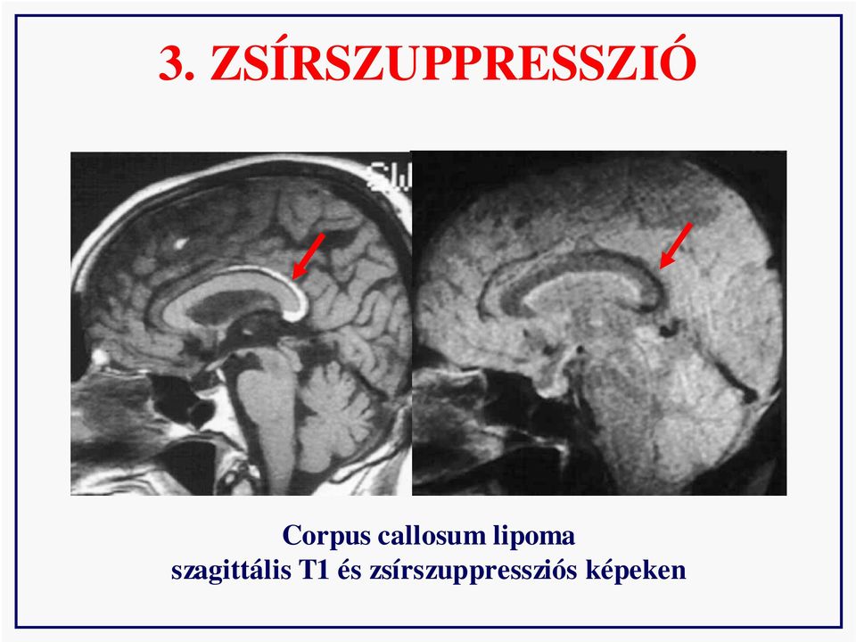 lipoma szagittális T1