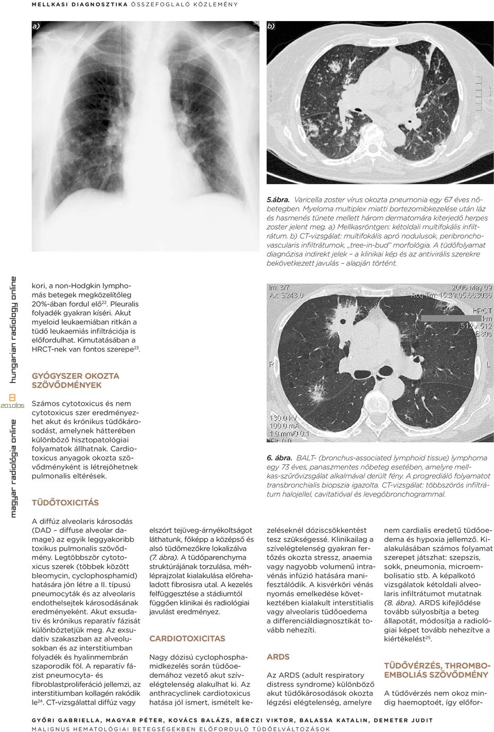 b) CT-vizsgálat: multifokális apró nodulusok, peribronchovascularis infiltrátumok, tree-in-bud morfológia.
