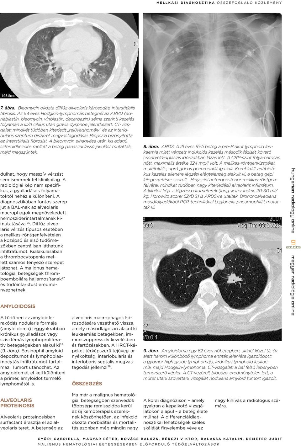 CT-vizsgálat: mindkét tüdőben kiterjedt tejüveghomály és az interlobularis szeptum diszkrét megvastagodásai. Biopszia bizonyította az interstitialis fibrosist.
