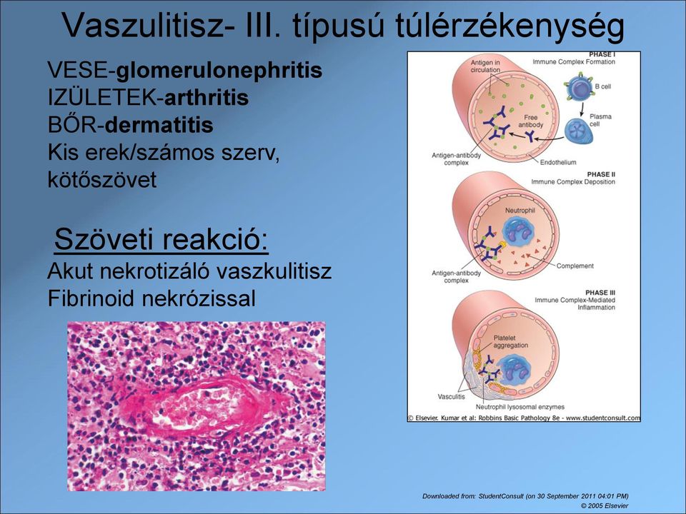 BŐR-dermatitis Kis erek/számos szerv, kötőszövet Szöveti reakció: