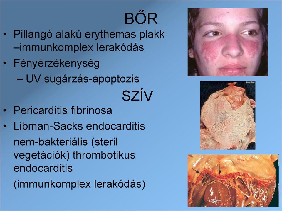 Az érgyulladás (vasculitis) tünetei és kezelése