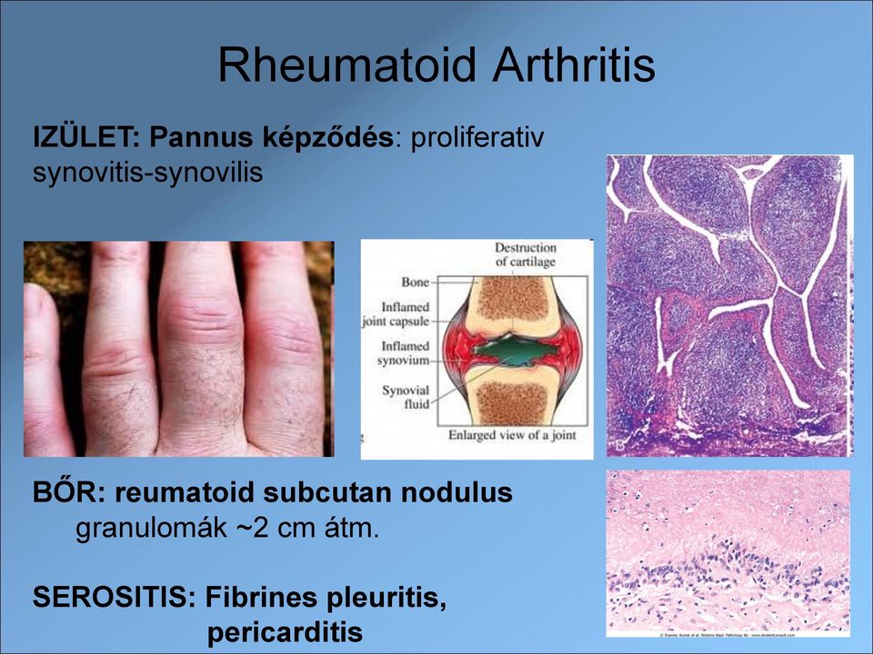 BŐR: reumatoid subcutan nodulus granulomák