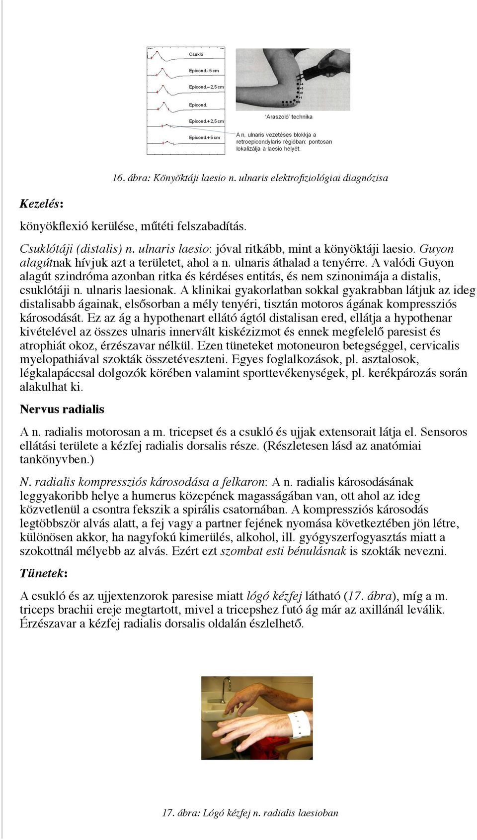 A valódi Guyon alagút szindróma azonban ritka és kérdéses entitás, és nem szinonimája a distalis, csuklótáji n. ulnaris laesionak.