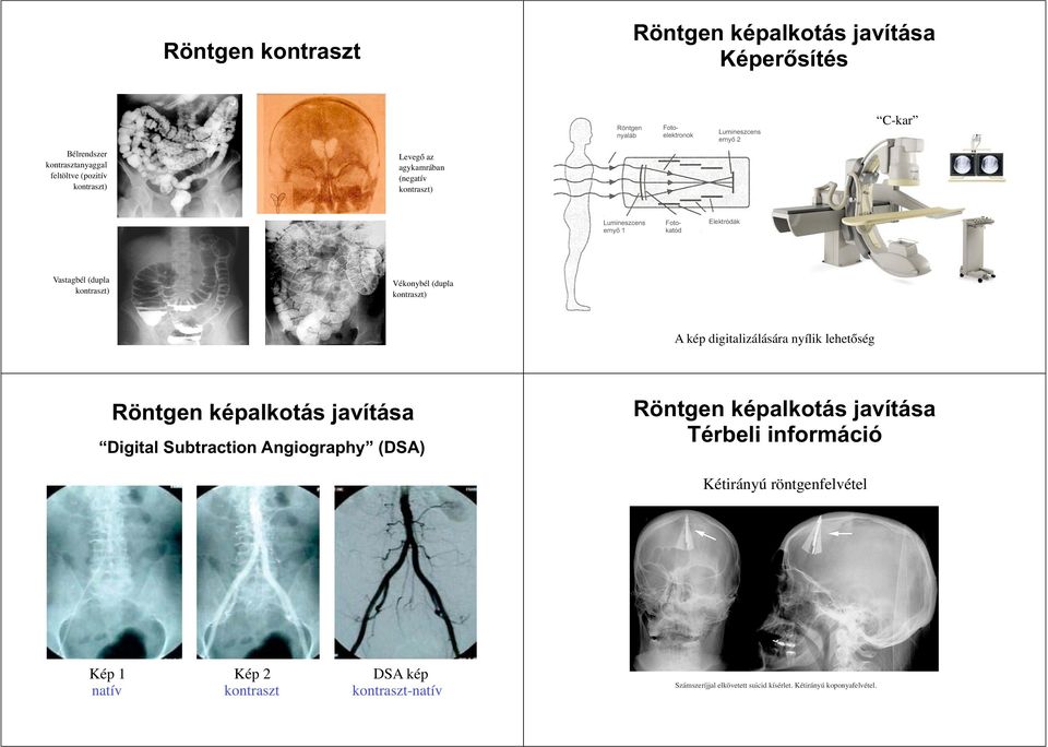 (dupla kontraszt) A kép digitalizálására nyílik lehetőség Röntgen képalkotás javítása Digital Subtraction Angiography (DSA) Röntgen képalkotás javítása