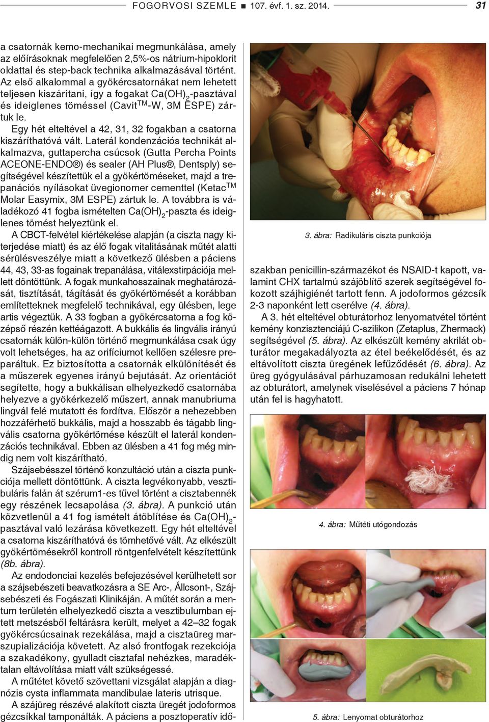 Az első alkalommal a gyökércsatornákat nem lehetett teljesen kiszárítani, így a fogakat Ca(OH) 2 -pasztával és ideiglenes töméssel (Cavit TM -W, 3M ESPE) zártuk le.