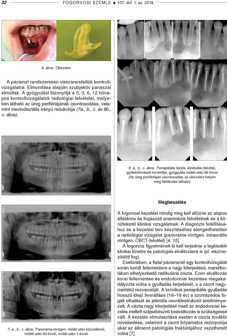 , c. és 8b., c. ábra). 8. a., b., c. ábra: Periapikális léziók: kiindulási felvétel, gyökértömések kontrollja, gyógyulás műtét után fél évvel (Az üreg perifériáján csontosodás, az obturátor helyén