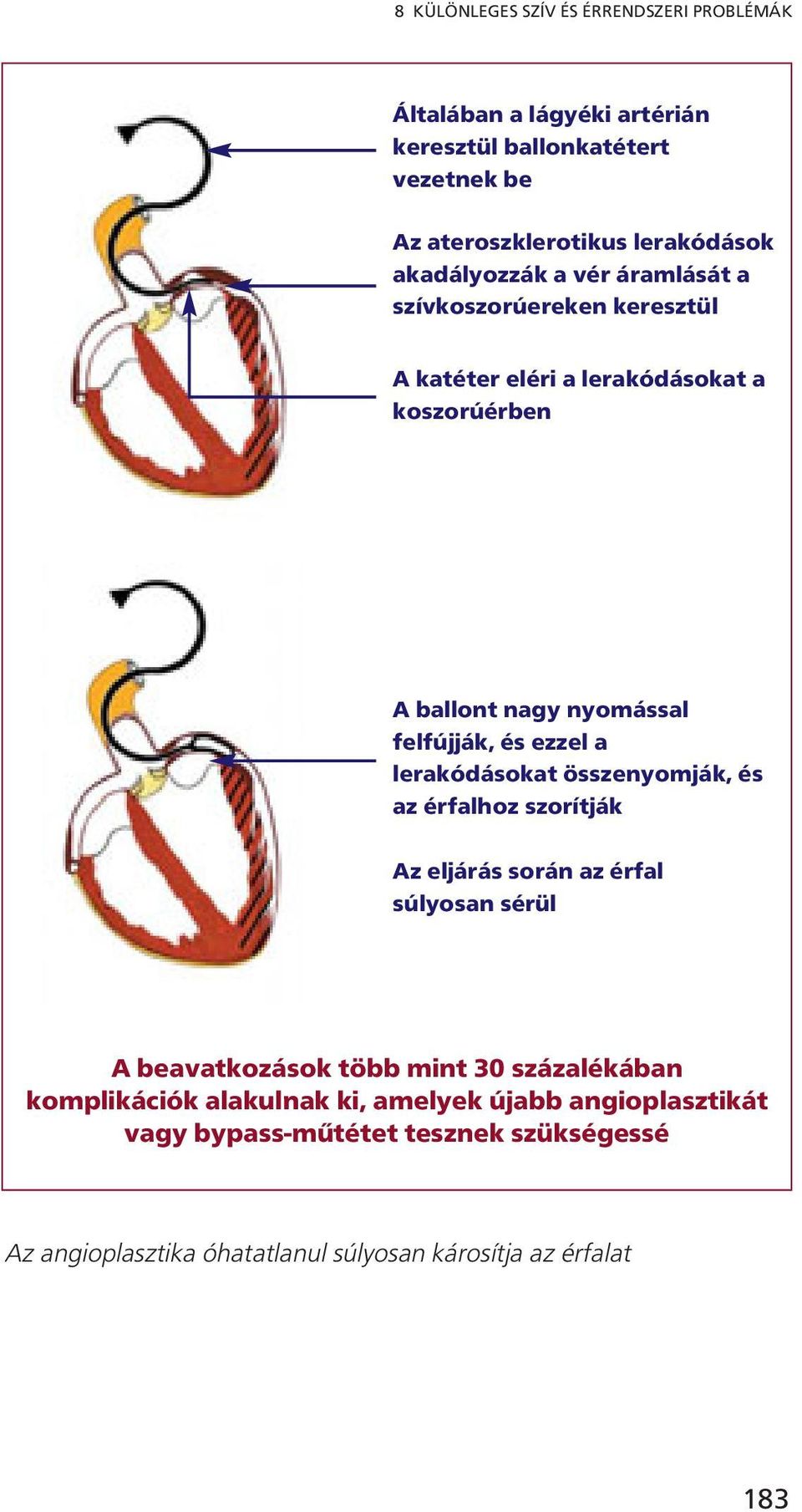 ezzel a lerakódásokat összenyomják, és az érfalhoz szorítják Az eljárás során az érfal súlyosan sérül A beavatkozások több mint 30 százalékában