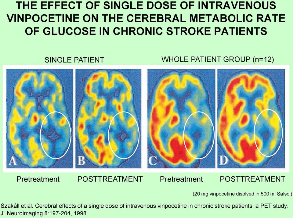 Pretreatment POSTTREATMENT (20 mg vinpocetine disolved in 500 ml Salsol) Szakáll et al.