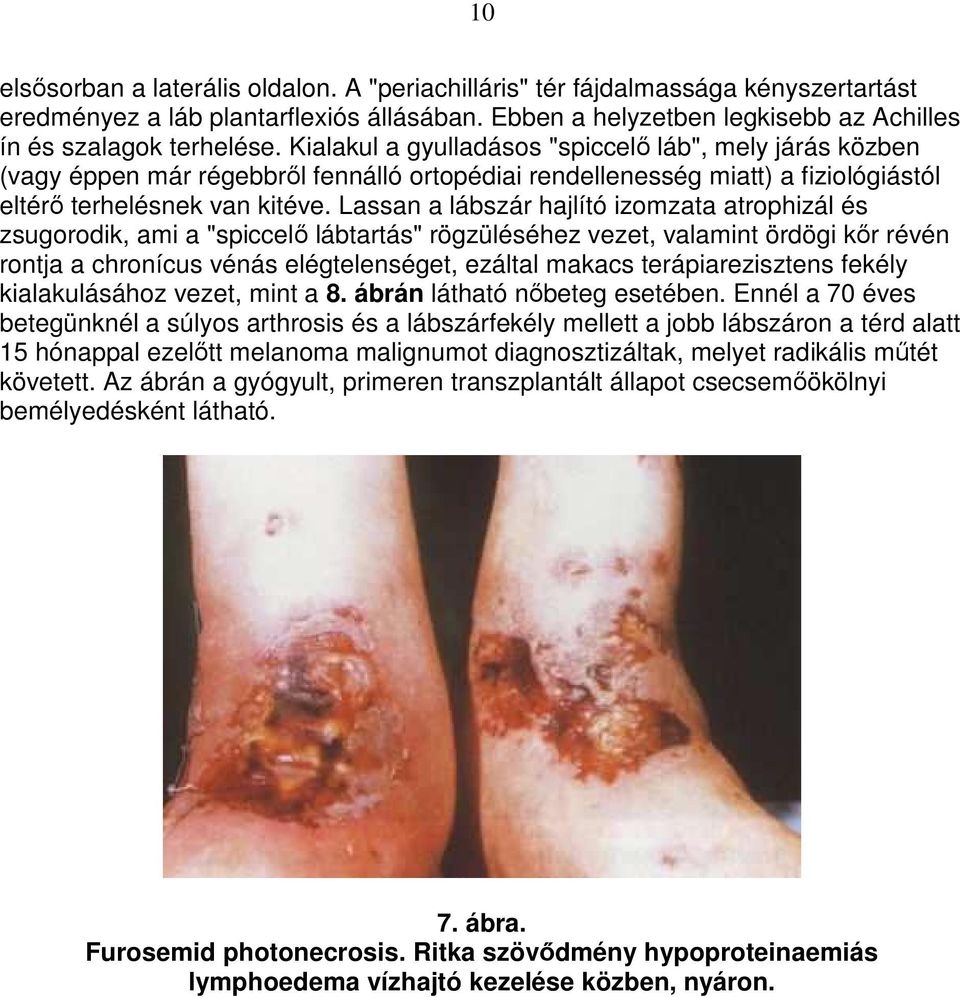 Lassan a lábszár hajlító izomzata atrophizál és zsugorodik, ami a "spiccelı lábtartás" rögzüléséhez vezet, valamint ördögi kır révén rontja a chronícus vénás elégtelenséget, ezáltal makacs